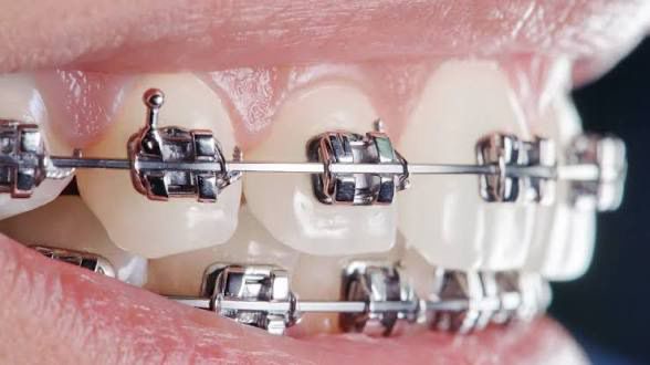 A model of a teeth with braces and braces