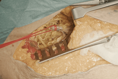 External iliac artery exposure