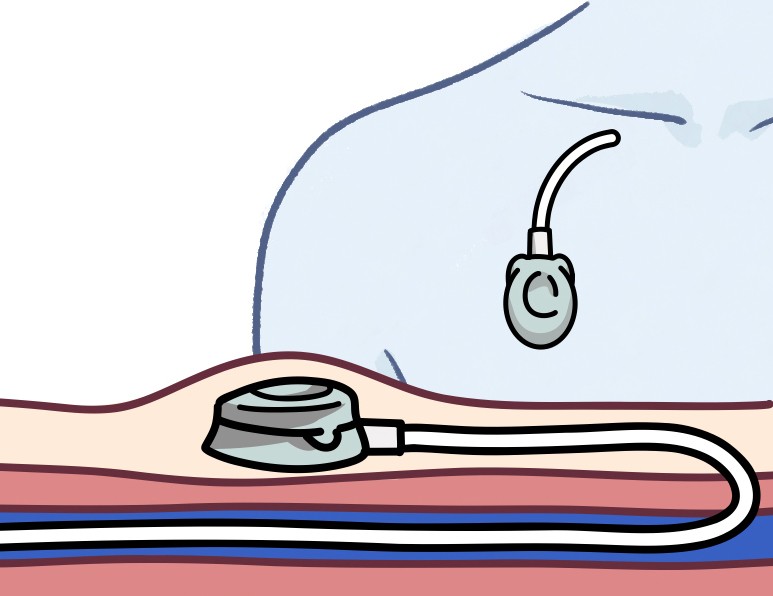 케모포트 일러스트