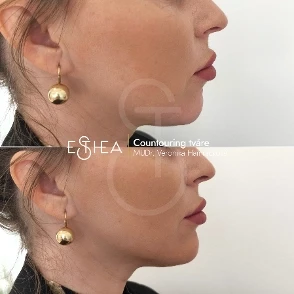 Koláž pred a po korekcii vpadnutej brady výplňou – dosiahnutie vyváženého a harmonického profilu tváre