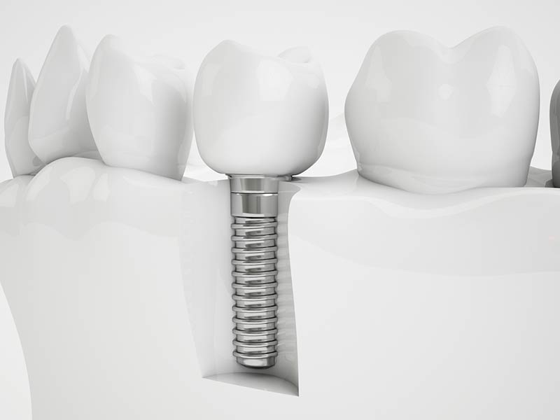 The Ultimate Guide to Teeth Whitening