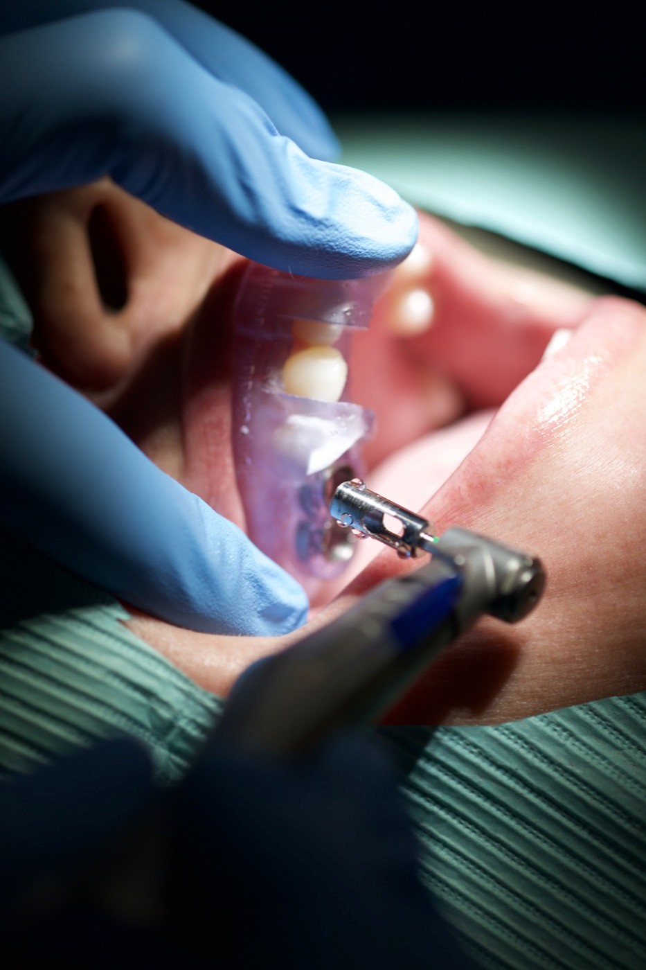 Osteotomy through the sleeve — Blue Sky Plan