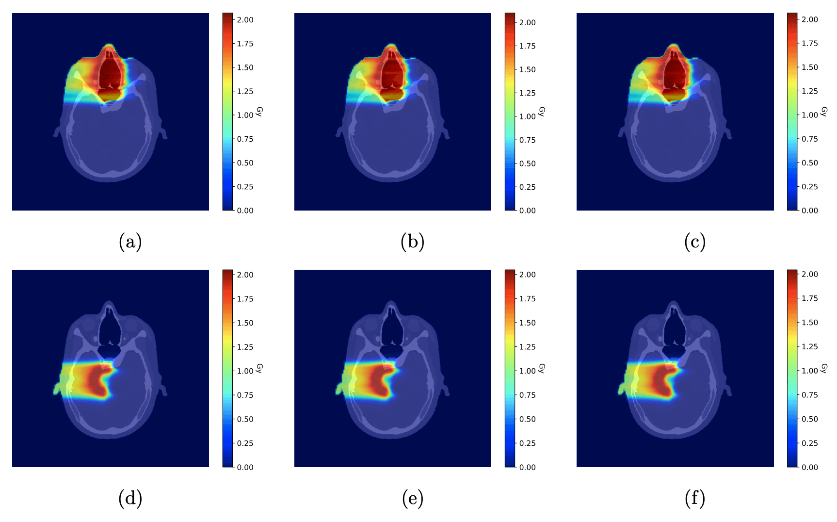 (a, d) Ground-truth dose distributions, calculated using known tissue compositions, for the nasal tumor (a) and brain tumor (d). (b, e) Dose distributions recalculated using a conventional single-energy CT stoichiometric calibration for the nasal tumor (b) and brain tumor (e). (c, f) Dose distributions recalculated using TissueXplorer, which derives tissue properties from spectral CT data, for the nasal tumor (c) and brain tumor (f). All plans deliver a single 2 Gy (RBE) fraction. Colors indicate dose in Gy.