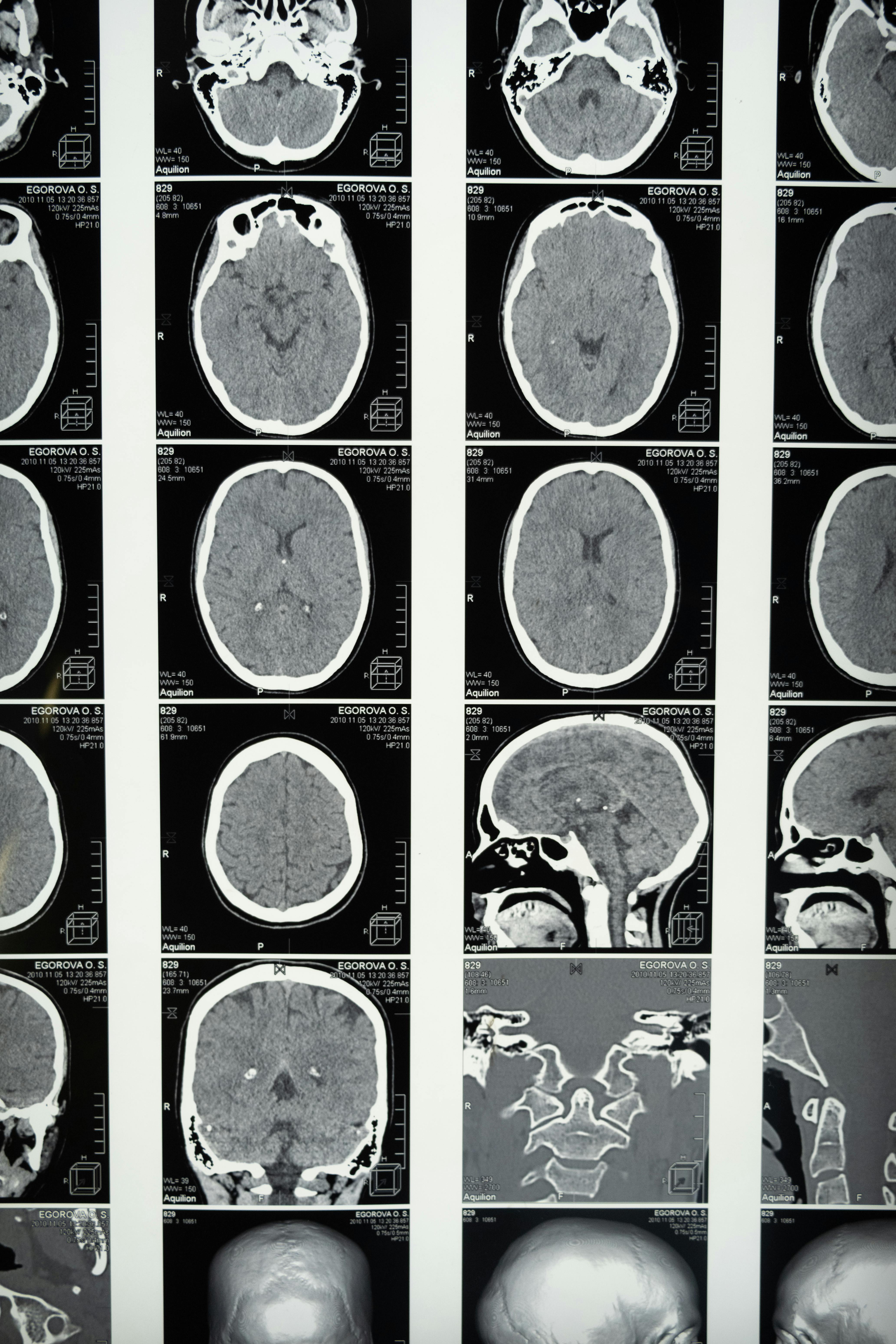 Brain MRI