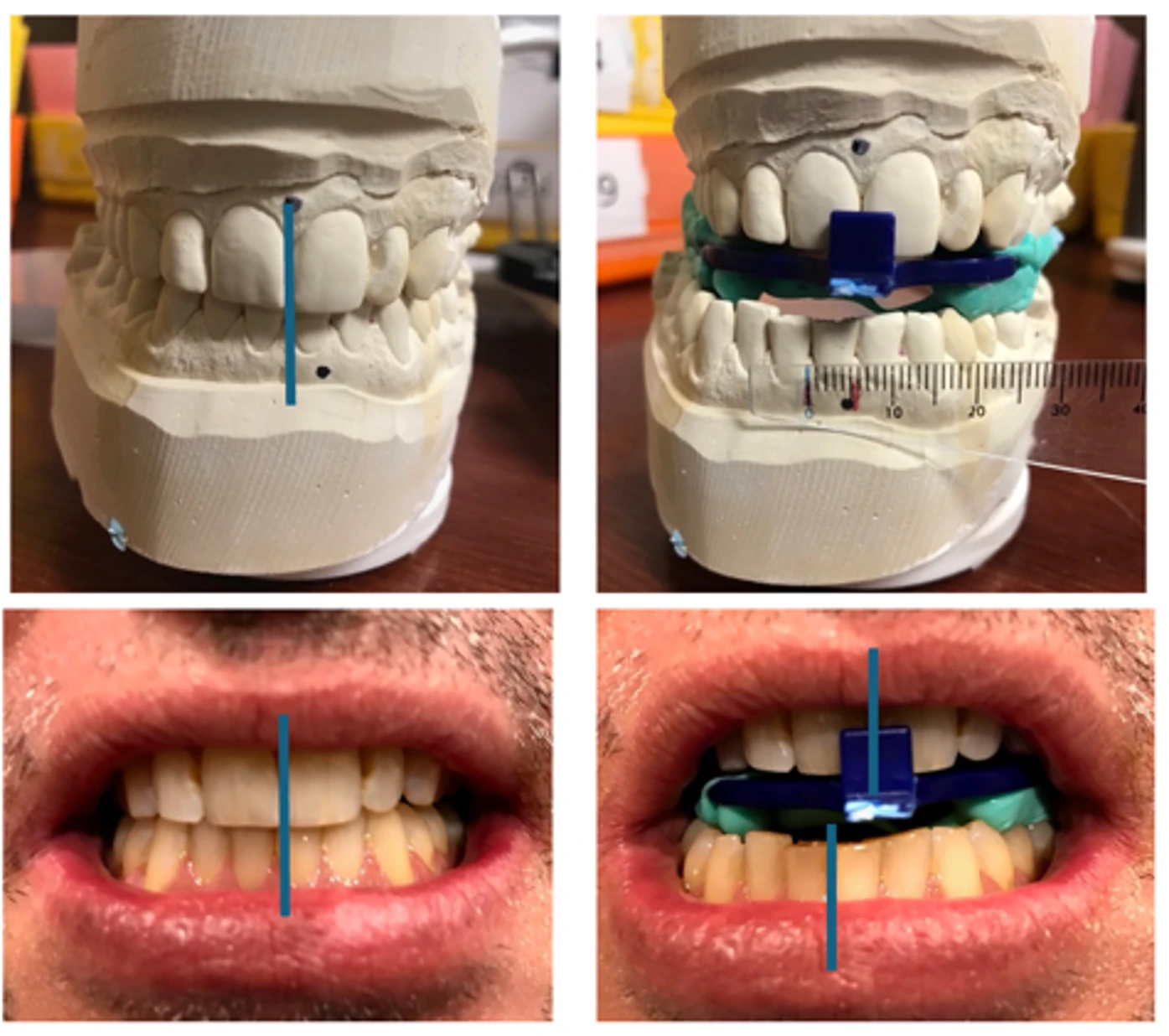 bite midline discrepancy