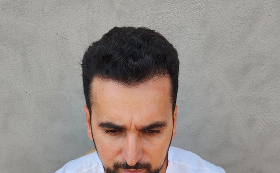 Homem mostrando como ficou seu cabelo depois do transplante. 