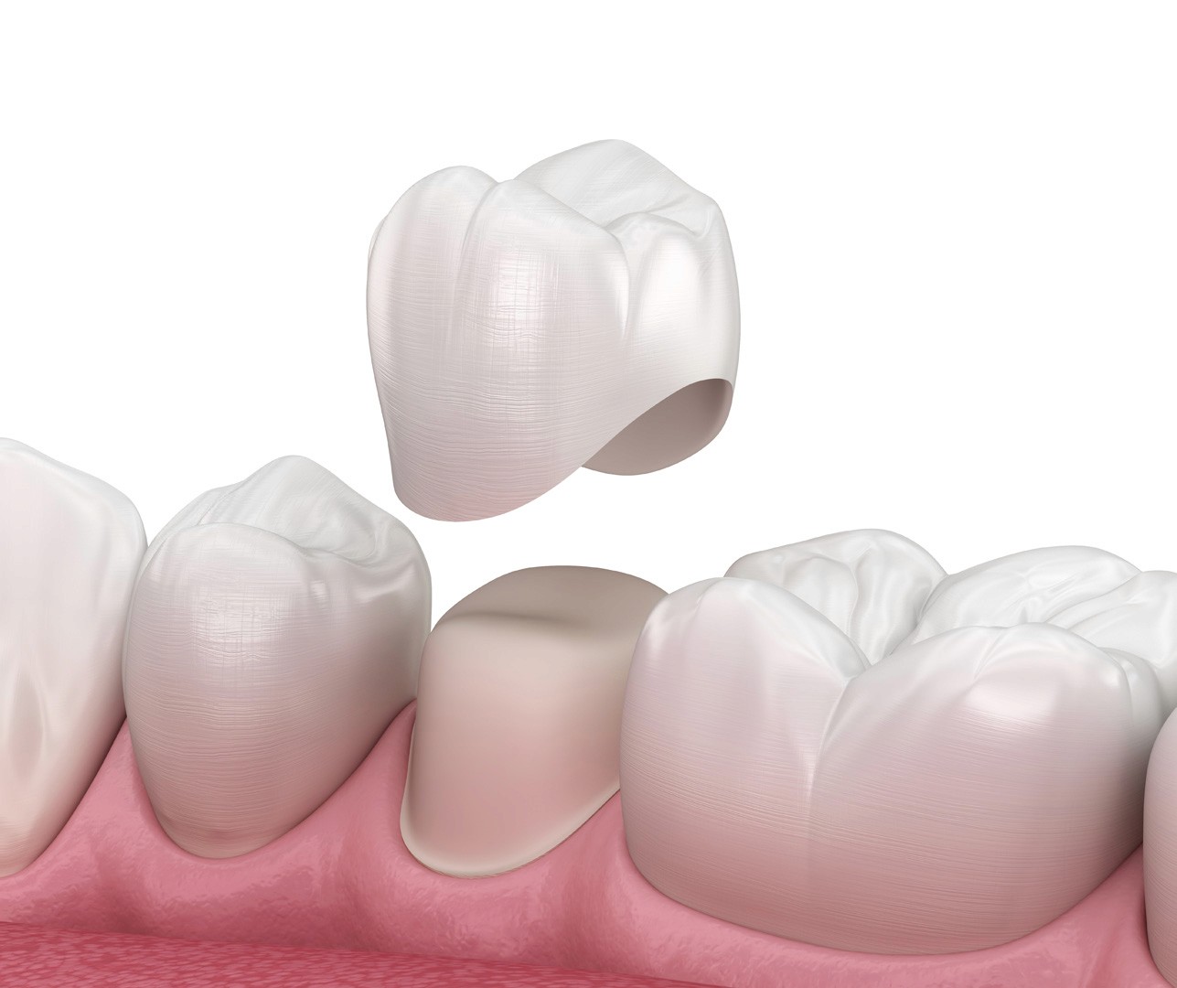 smyrna dental crowns