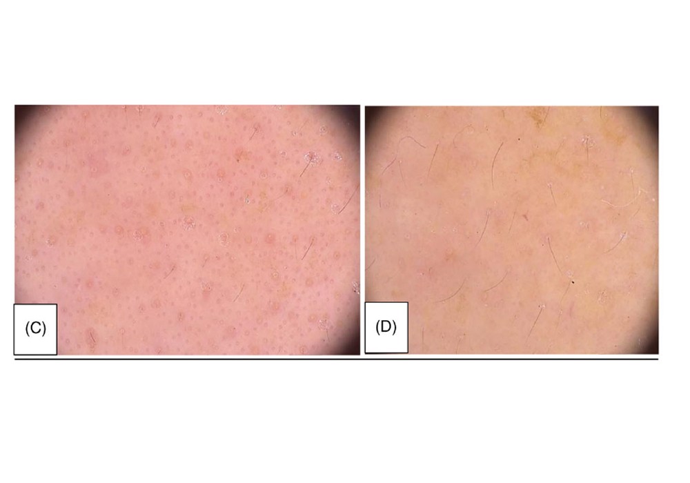 The efficacy of intra dermal injections of botulinum toxin in management of enlarged facial pores and seborrhea: A split face controlled study