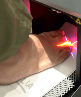 발톱무좀 치료를 위한 풋레이저 시술 장면