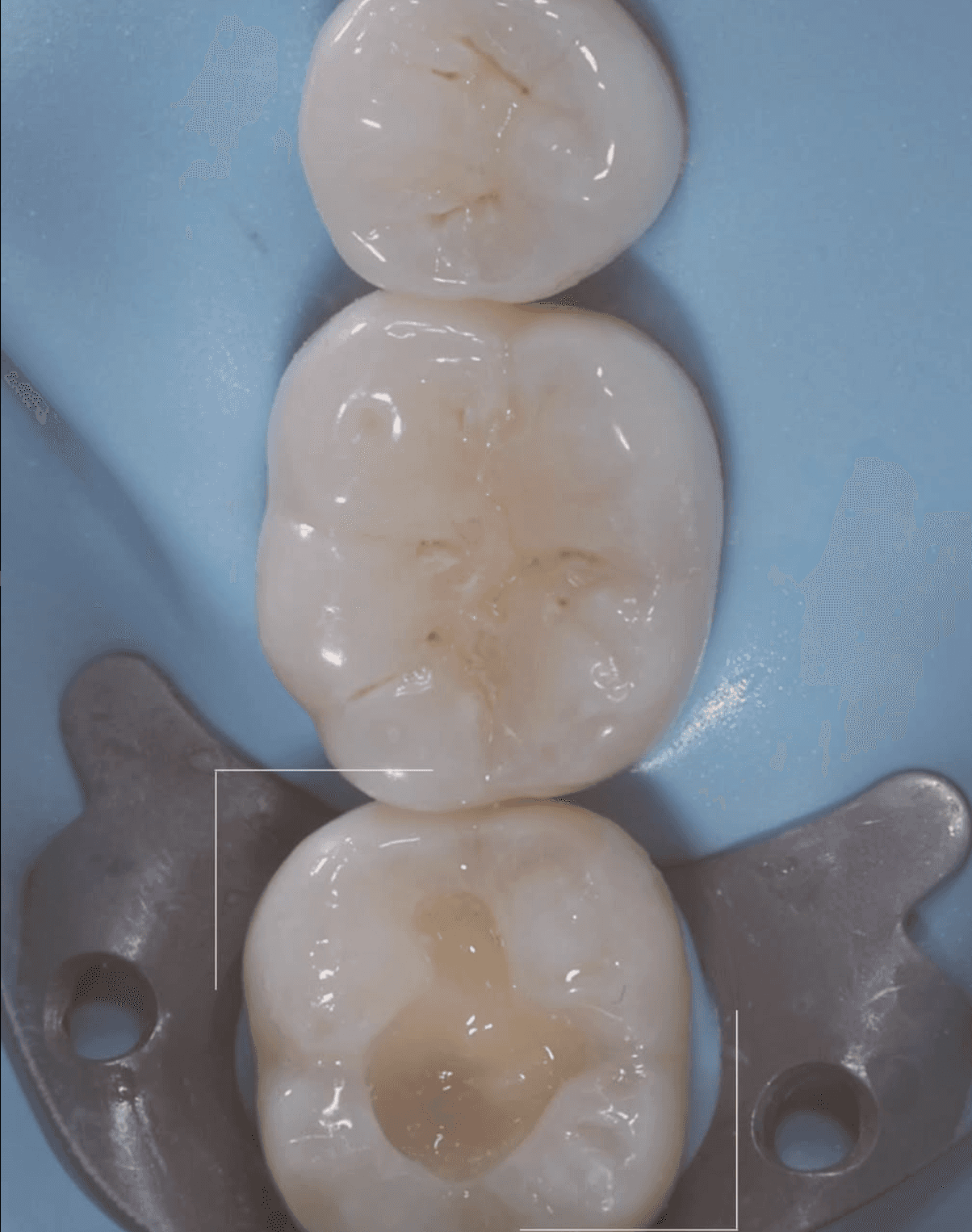 Ribbond perfekt platziert