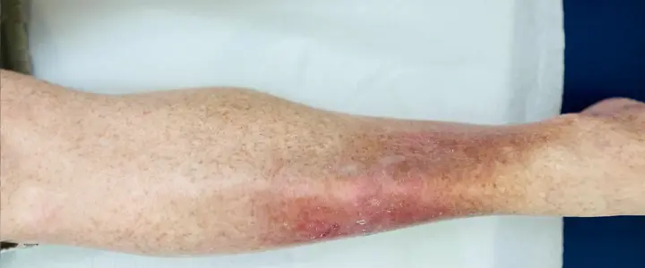 Red, swollen, flaky lower legs/ankles with possible brown staining