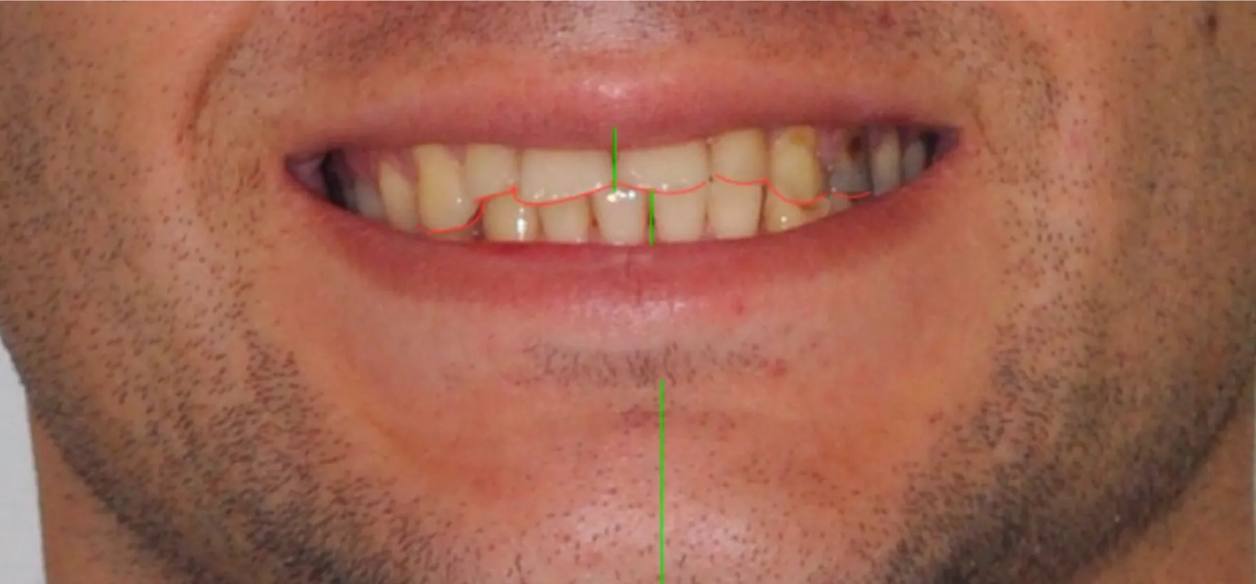Harmonised occlusion and aesthetic restorations. No surgery