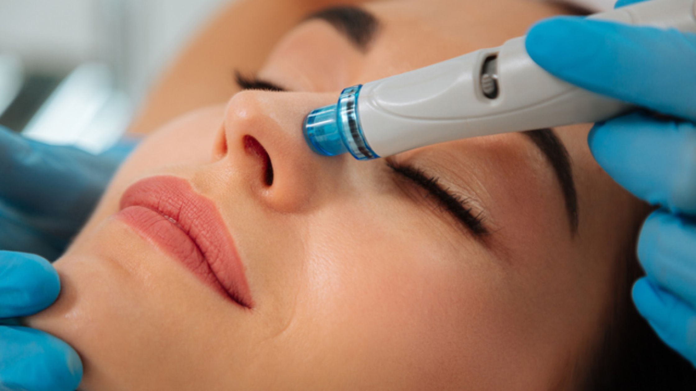 How Often Should You Get Microneedling in Frisco