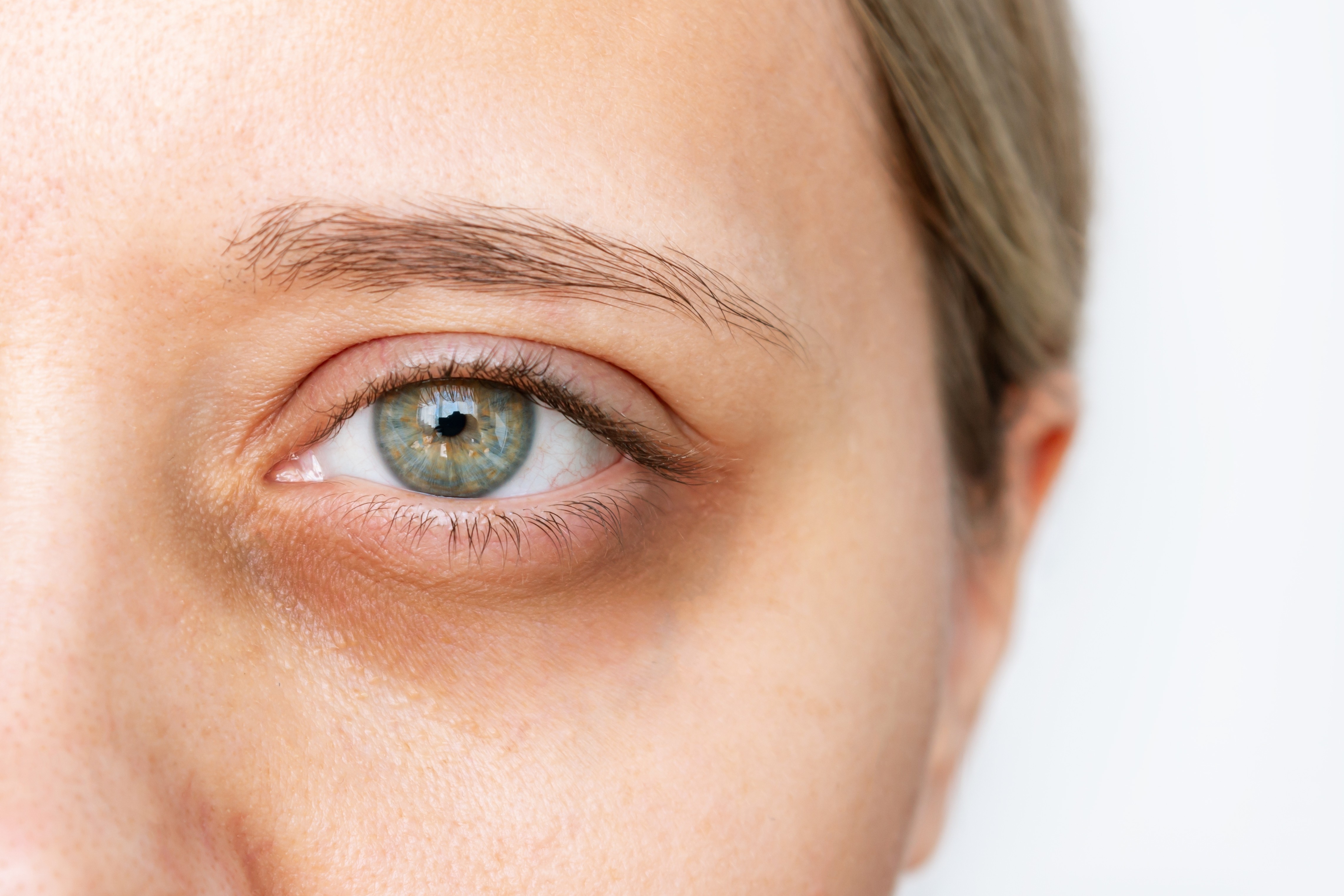 dark circles under the eyes explained and list of treatments at bella medical centre in Abu Dhabi, including radio frequency, laser, and others