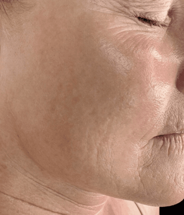 Before Microneedling