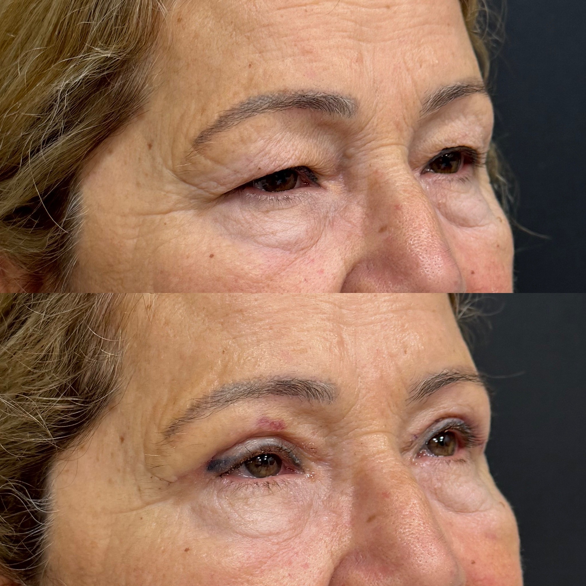 upper blepharoplasty surgery result before after photo 7 days post-surgery left oblique view