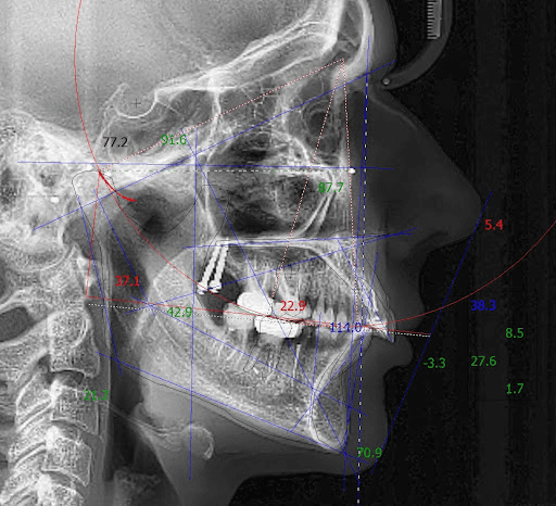 Lateral and frontal x-rays (cephalometric analysis)