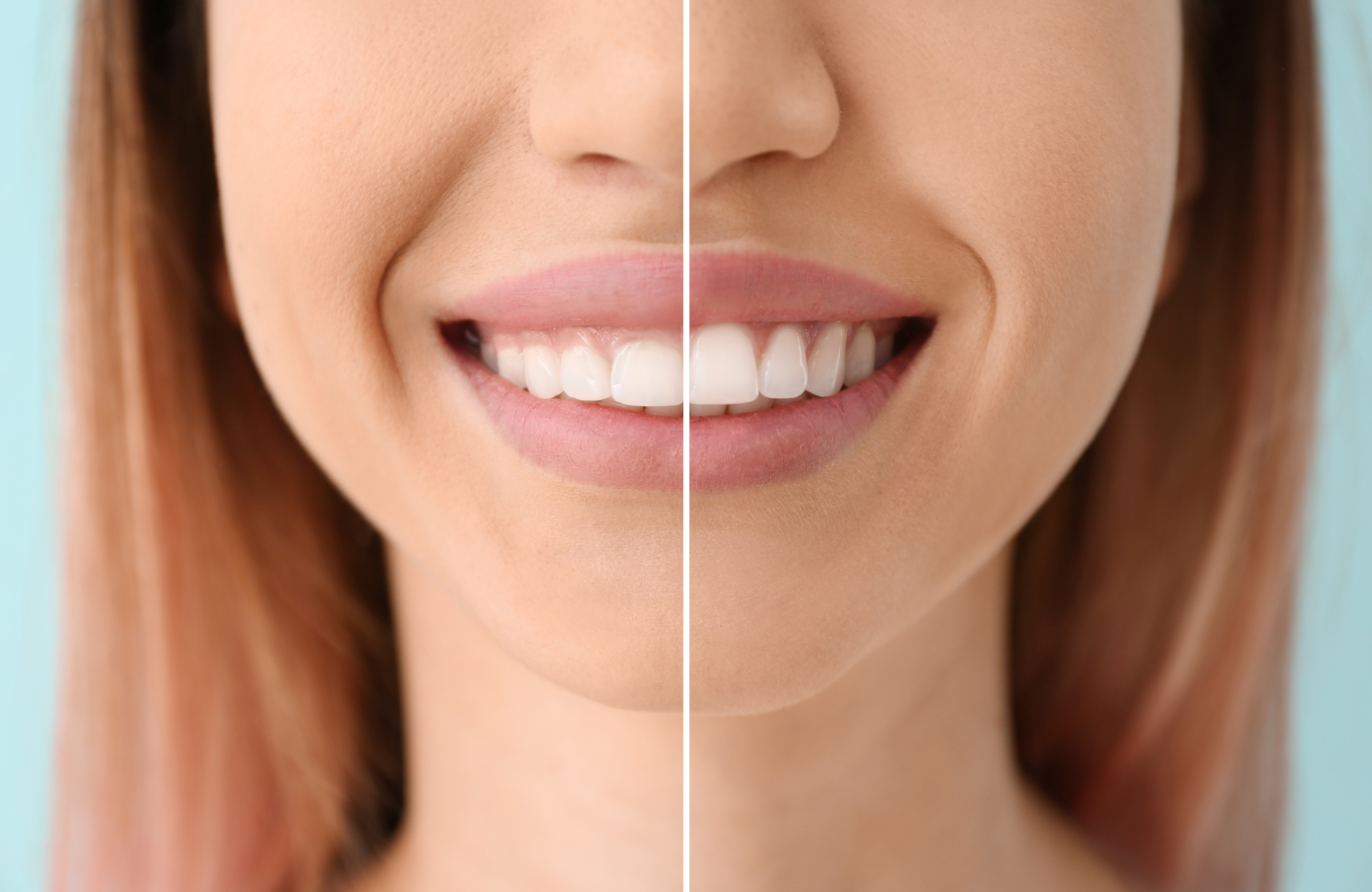 Gummy smile before and after treatment
