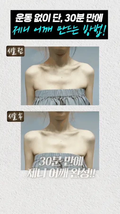 위영진 원장의 실전 노트: 쥬베룩글램으로 완성하는 슬림 어깨 라인