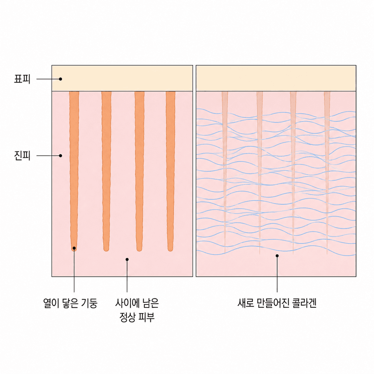 기둥 사이에 남은 정상 피부가 재생을 이끌어요.