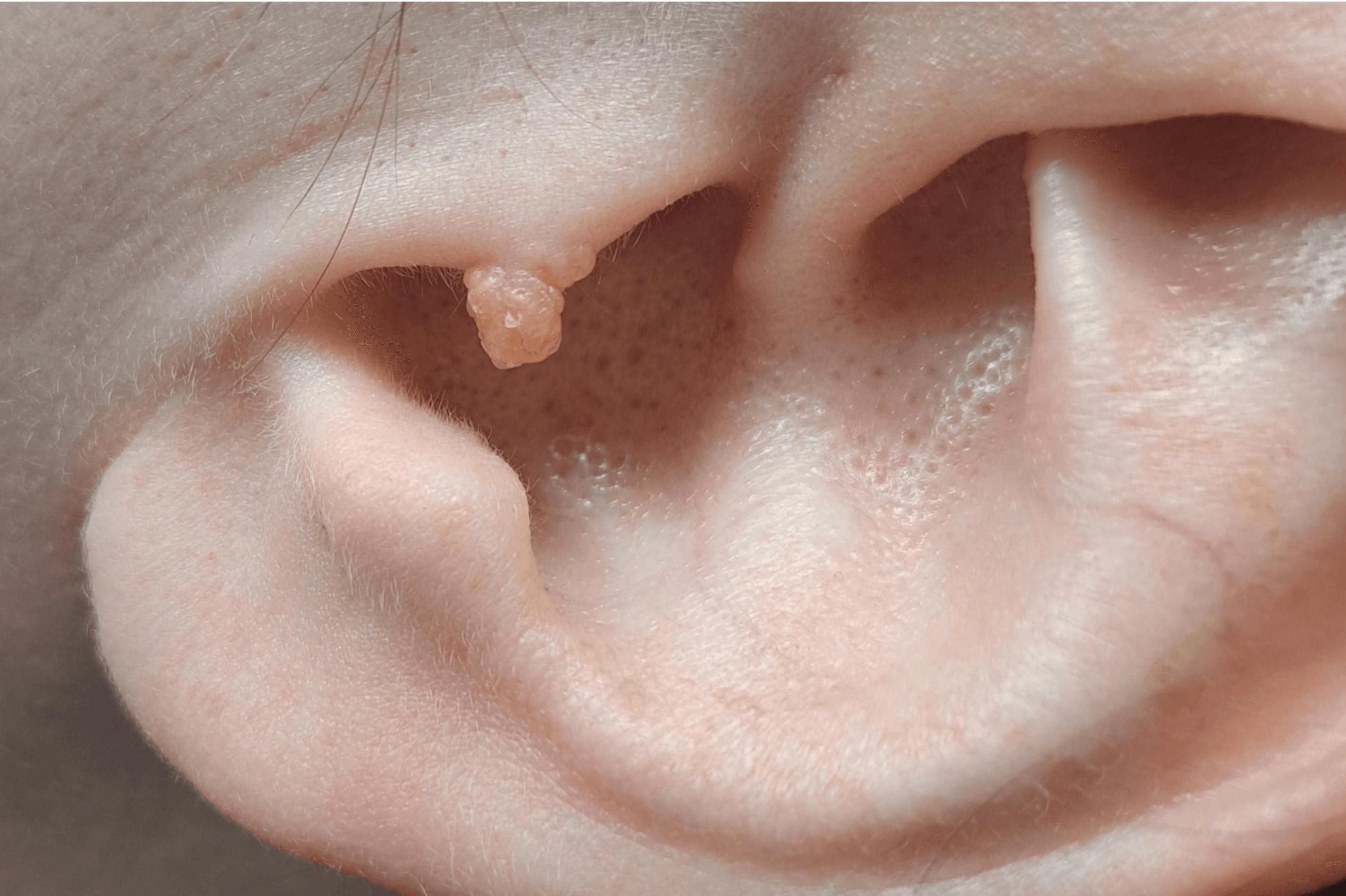 Skin tag removal in winnipeg by Dermagraphics Skin Studio