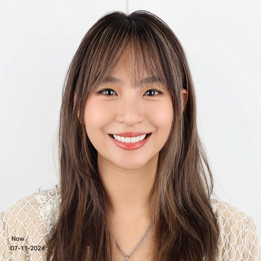 รีวิวออกแบบรอยยิ้มวีเนียร์ cosdent smile design