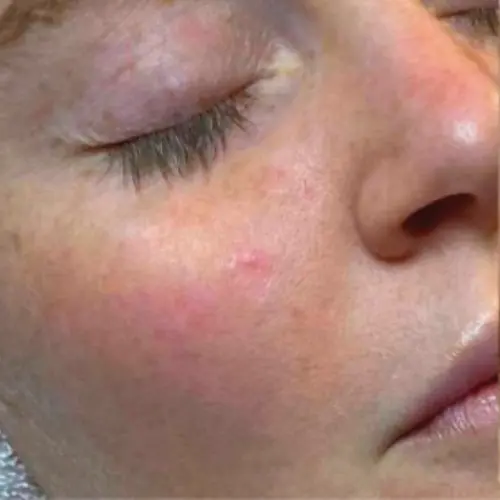 Before HydraFacial MD at The Vancouver Aesthetician — dull uneven skin tone with visible enlarged pores