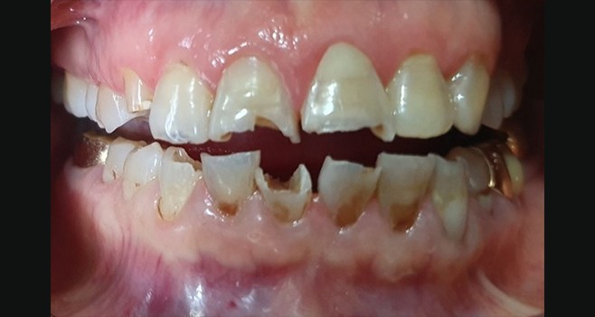 고도손상 치아 초진 사진