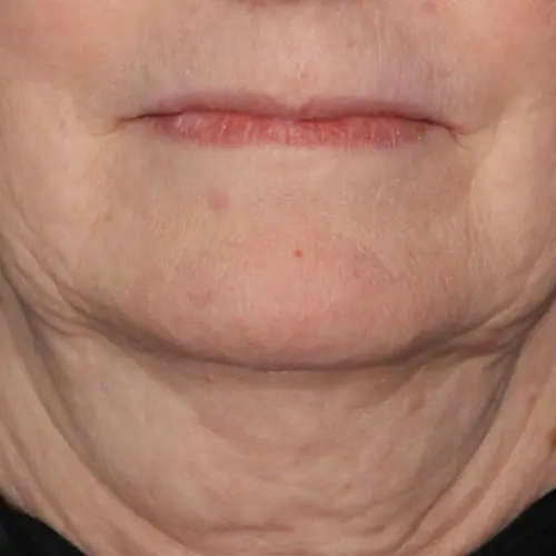 Before peptide therapy at The Vancouver Aesthetician — visible neck and jowl sagging with deep wrinkles and loss of definition
