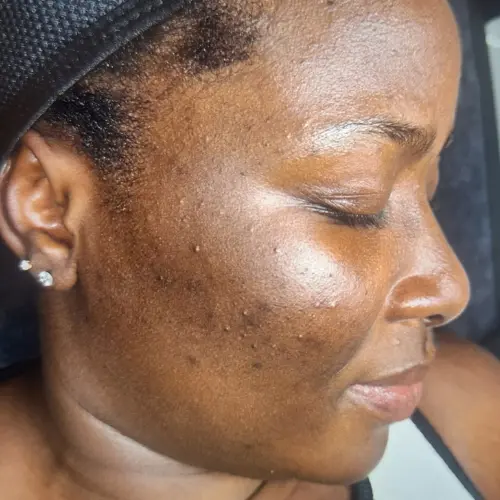 Before pigmentation discolouration treatment at The Vancouver Aesthetician — visible hyperpigmentation, post-inflammatory discolouration and dark acne scar marks on skin