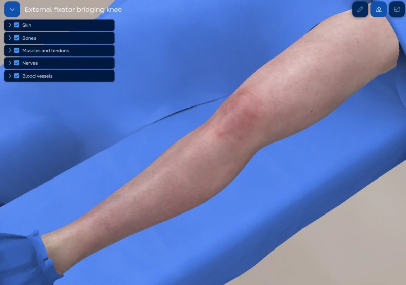 Knee spanning external fixation