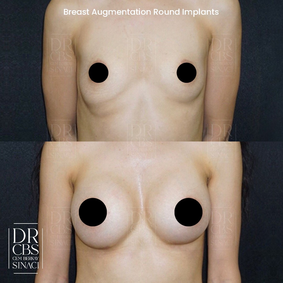 3 months breast implant dual plane before after front view