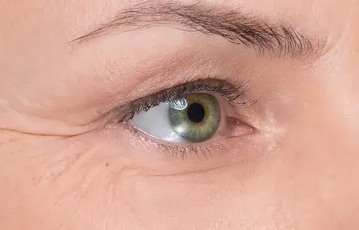 Close-up of eye area after Botox treatment for dynamic wrinkles, reducing crow’s feet and smoothing fine lines for youthful skin.