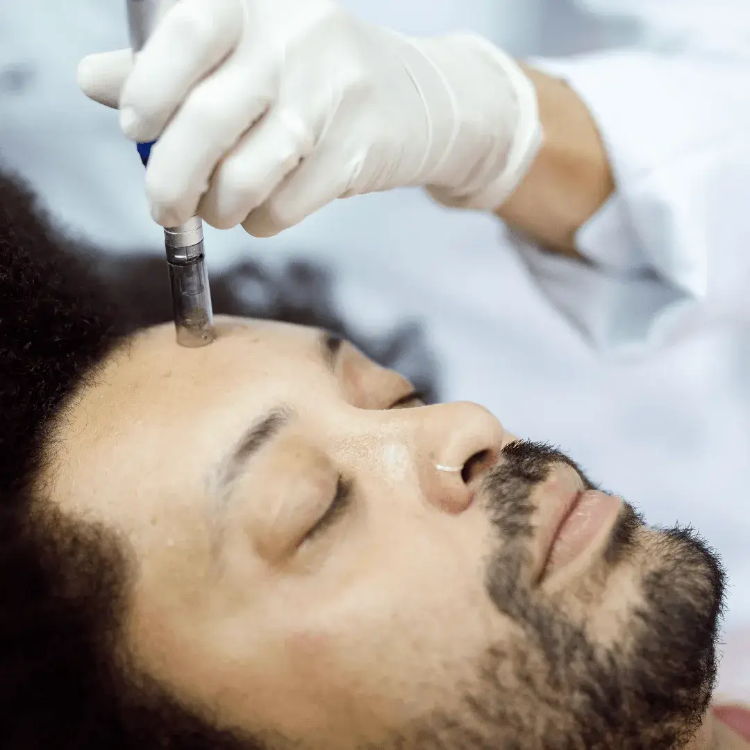 Man receiving microneedling facial treatment to stimulate collagen production, improve skin texture, and reduce scars and wrinkles.