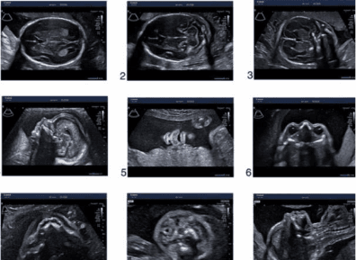 A collage of ultrasound images

AI-generated content may be incorrect.