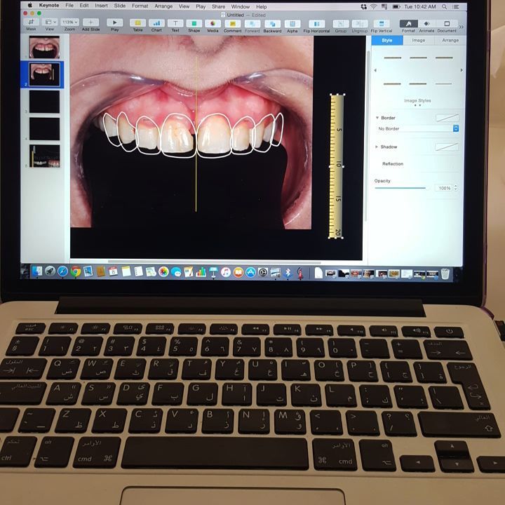 Dental veneers Dubai use digital smile design to create precise, natural-looking results tailored to your features and proportions.
