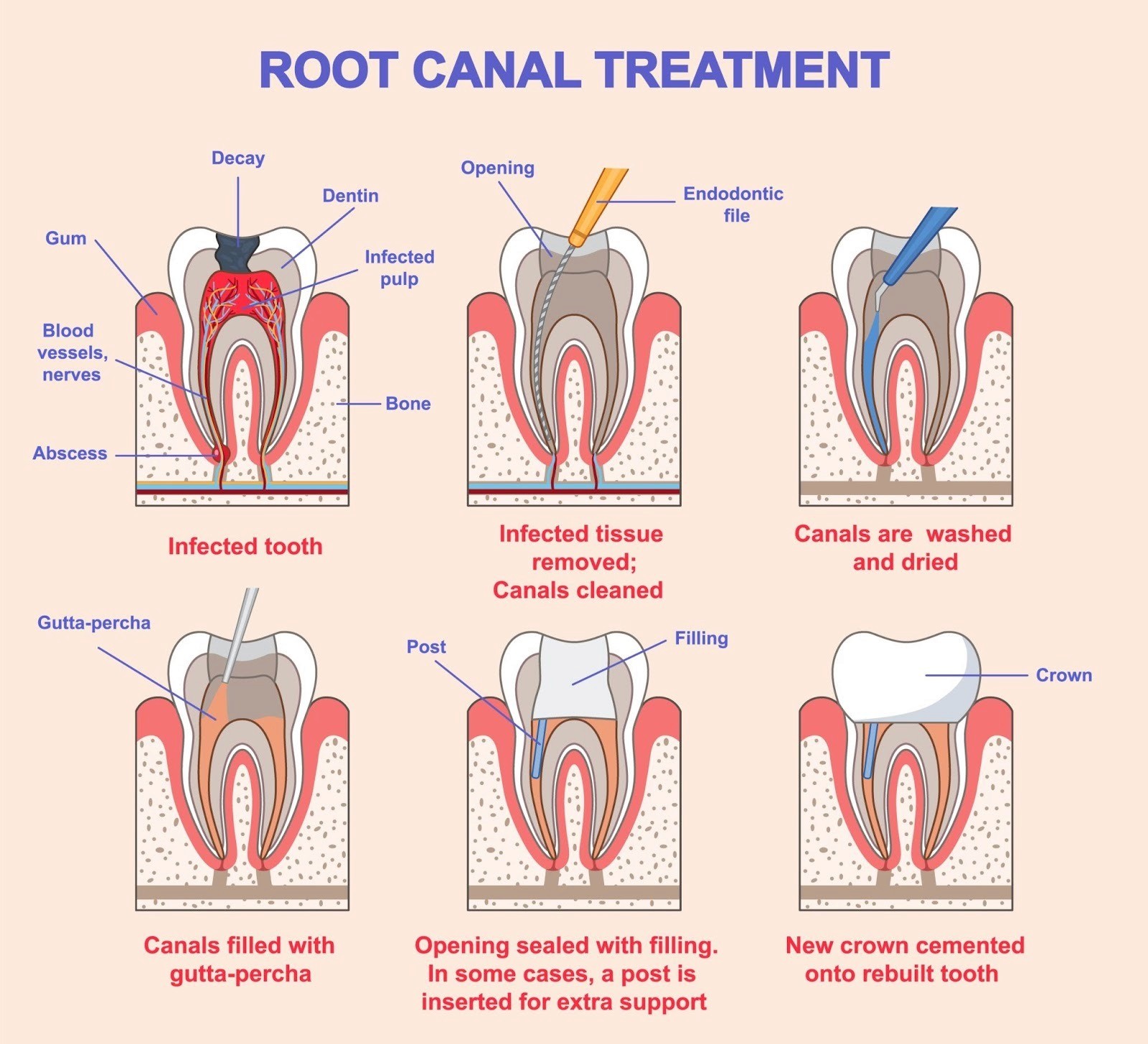 Image of a diagram showing a root canal procedure