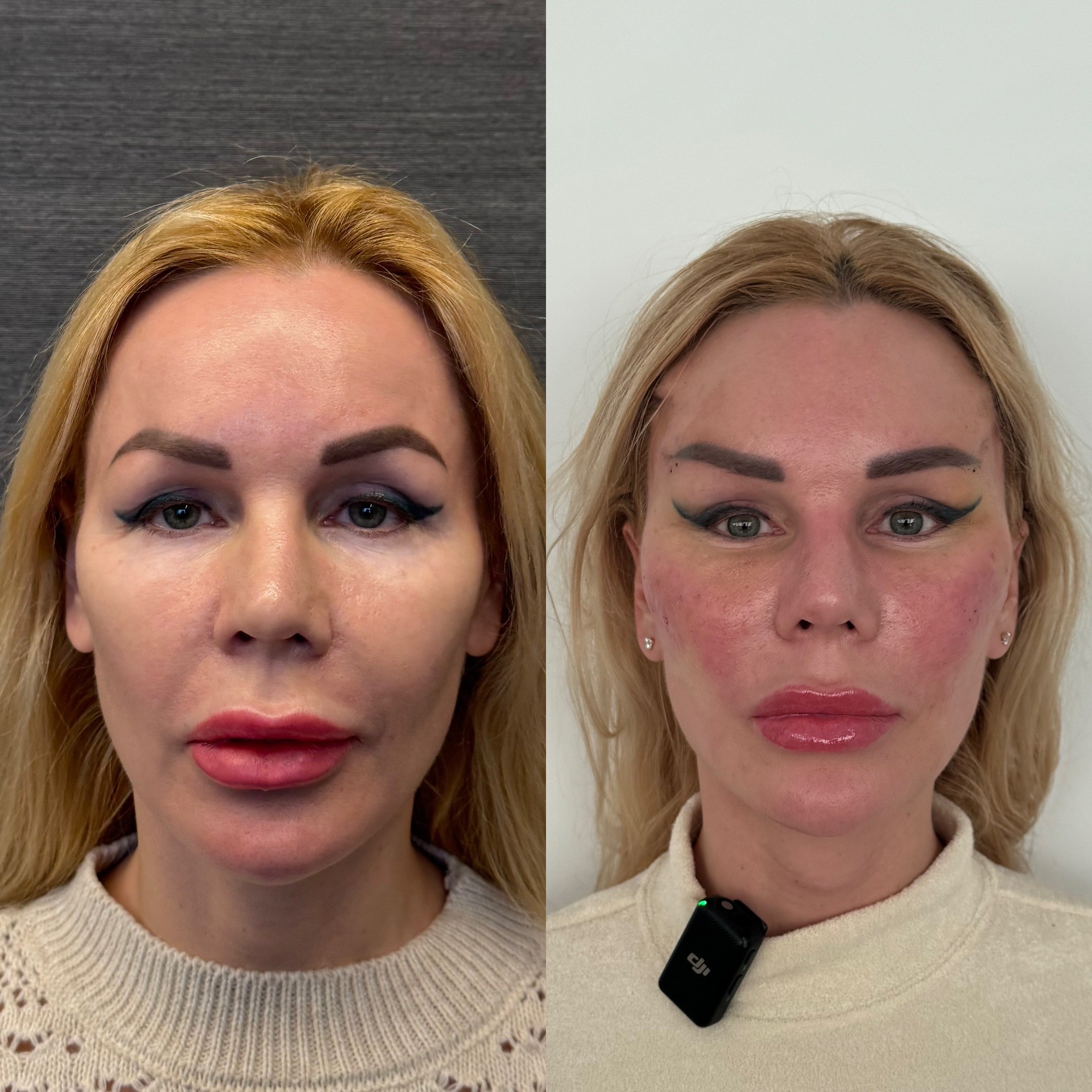 6 days before after photo of temporal face brow lift front view