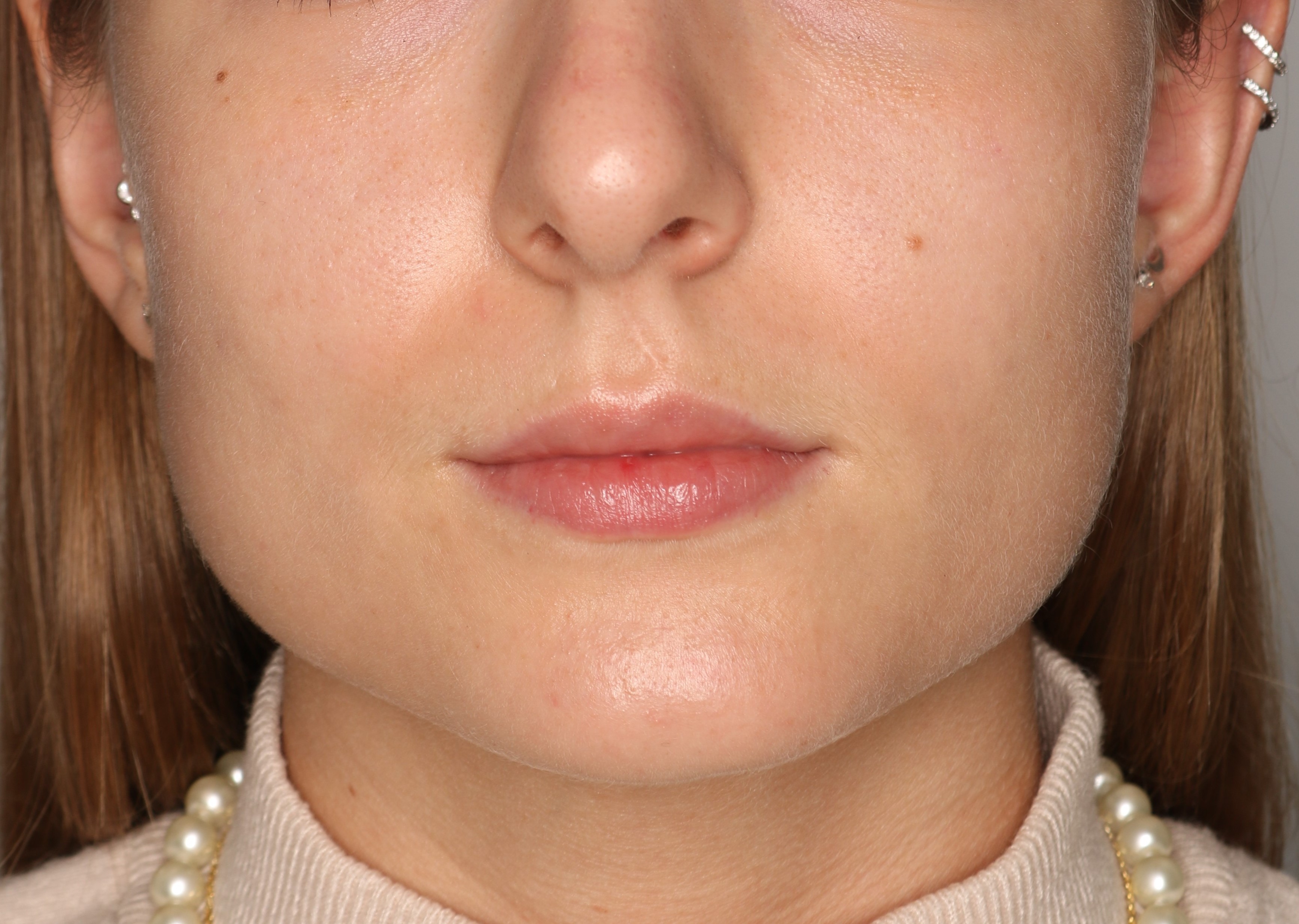 Efekt zabiegu toksyna botulinowa - Przed 3