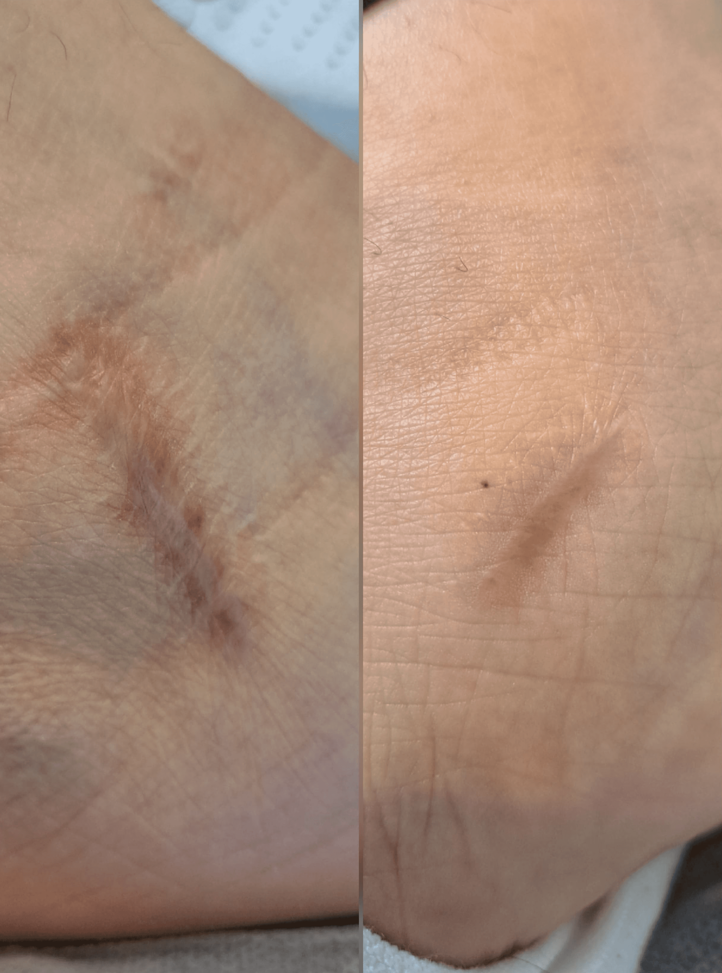 Neuroscars neurolifting_neurorehabiltacja_szczecin_wrocÅaw_efekt_jednego_zabiegu_estGen_leszczenko