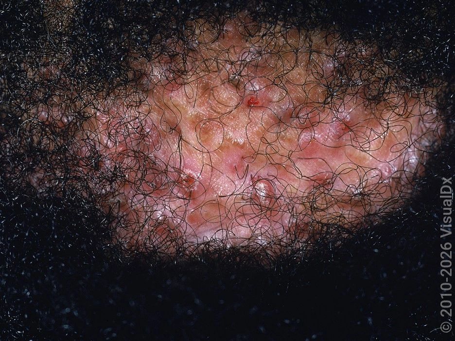 Folliculitis Decalvans — image from NorCal Hair Doctor™'s existing website