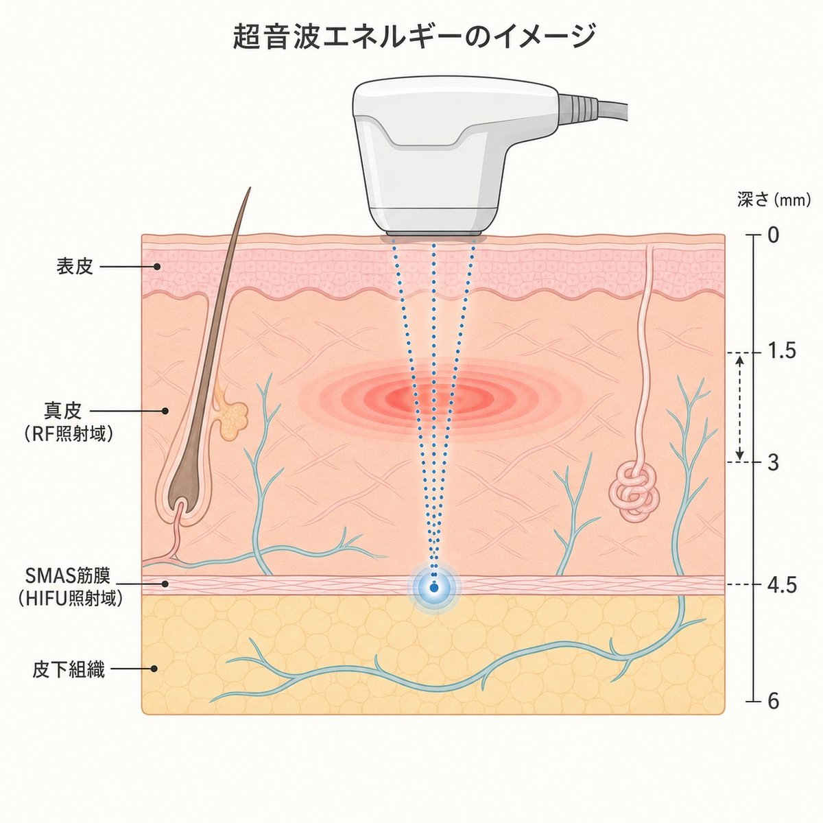 HIFUと高周波（RF）が到達する皮膚層の深さの違いを示す断面図