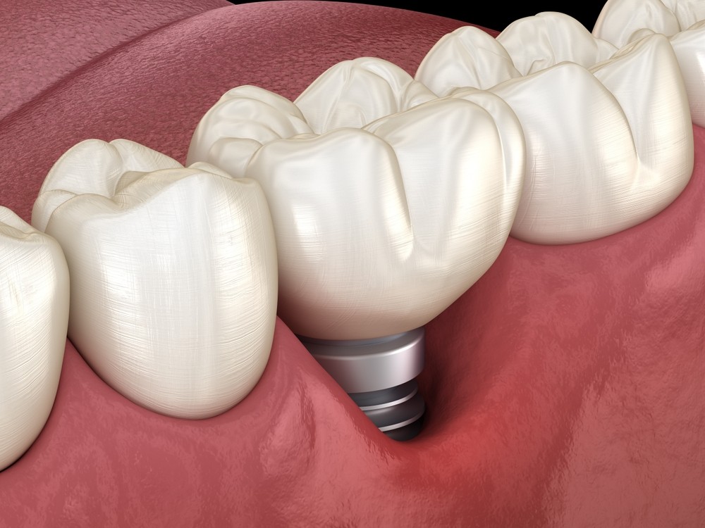 3D model of a single tooth dental implant in Dubai at Invisalign Center, replacing one missing tooth naturally and securely.