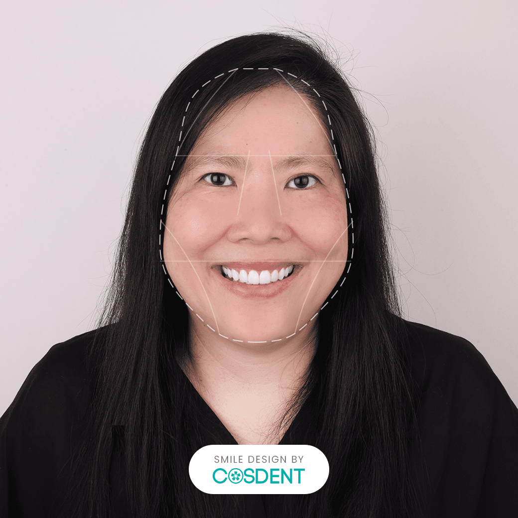 หน้ารูปลูกแพร์ ยิ้มกว้าง 16 ซี่