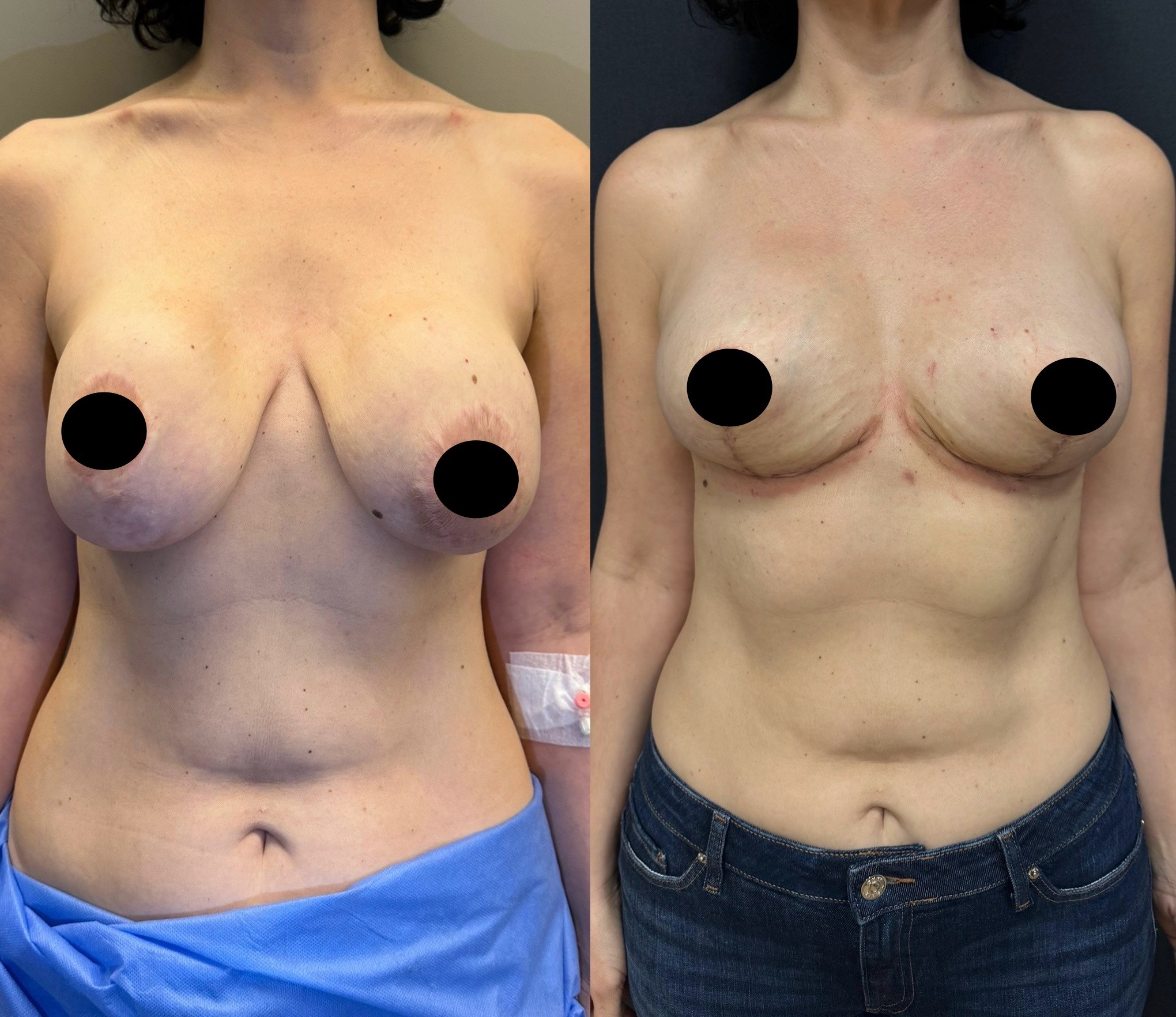 waterfall deformity correction before after breast lift with implant revision front view