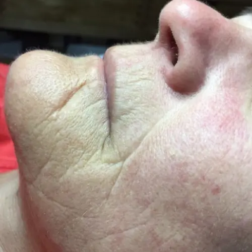 Before LED light therapy at The Vancouver Aesthetician — visible fine lines, wrinkles, and uneven skin tone