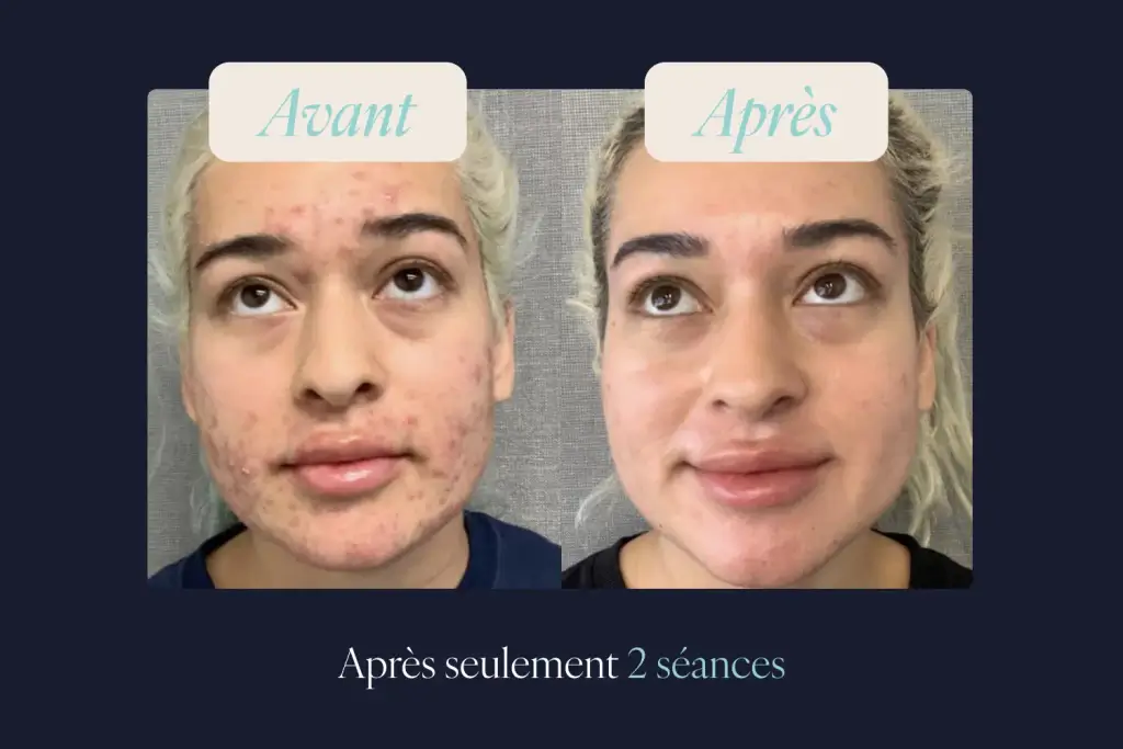 avant-après epilation laser visage moustache