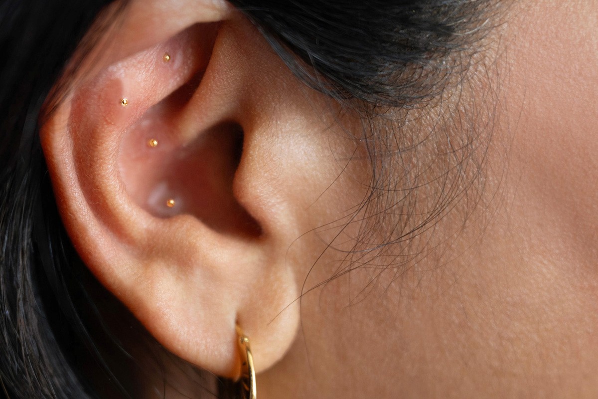 A delicate arrangement of tiny gold seeds placed in a patient’s ear, offering a gentle and non-invasive treatment.