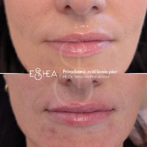 Fotografia pred a po korekcii asymetrie pier jemnou kyselinou hyalurónovou pre symetrický a prirodzený výsledok