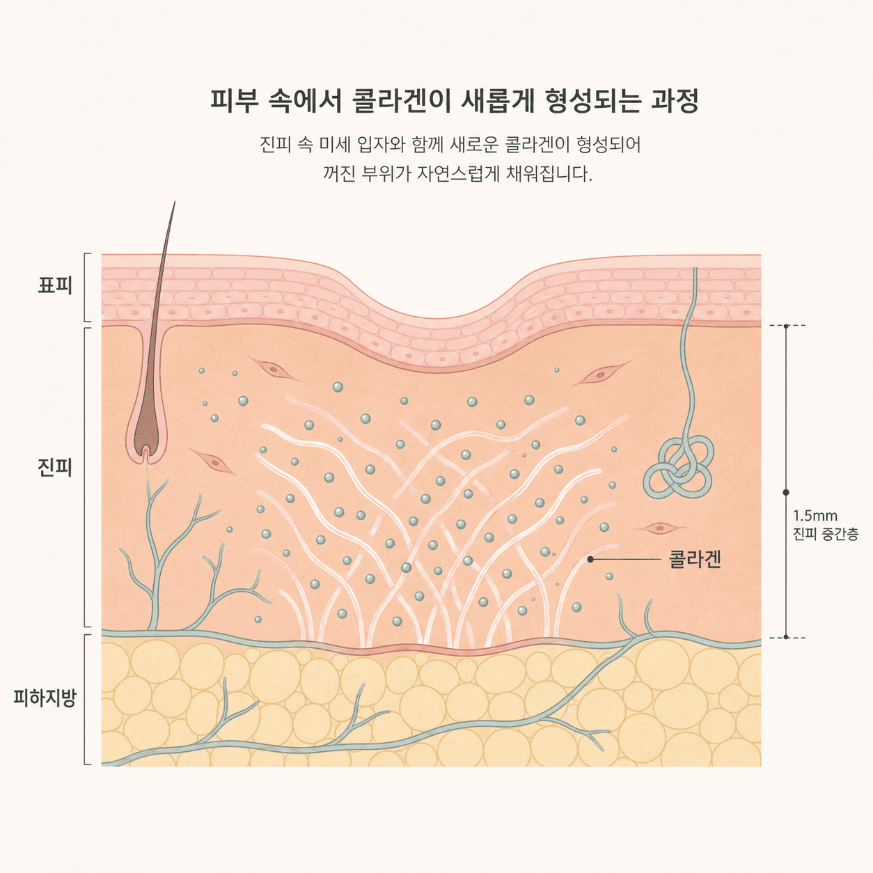 โครงสร้างที่คอลลาเจนใหม่ค่อยๆ เติมเต็มชั้นผิวหนังแท้ในบริเวณที่ตอบ